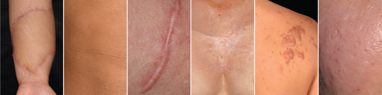HOW TO HEAL SCARS