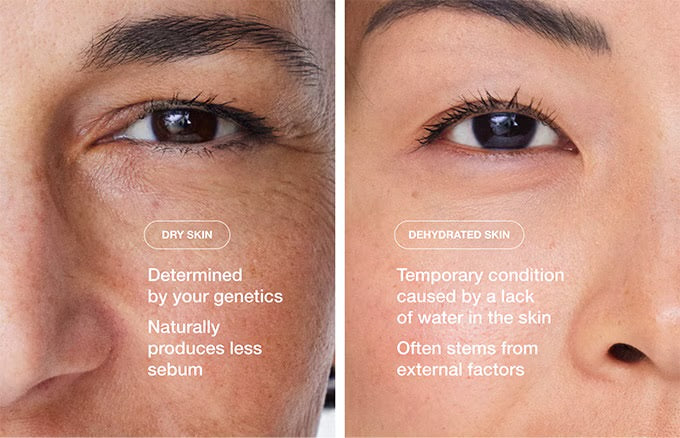DRY OR DEHYDRATED SKIN?