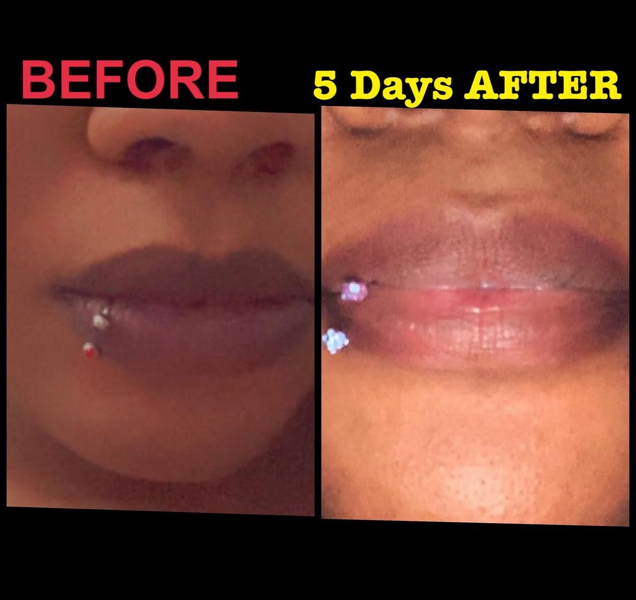Permanent Pink Lip Kit (100% Effective)